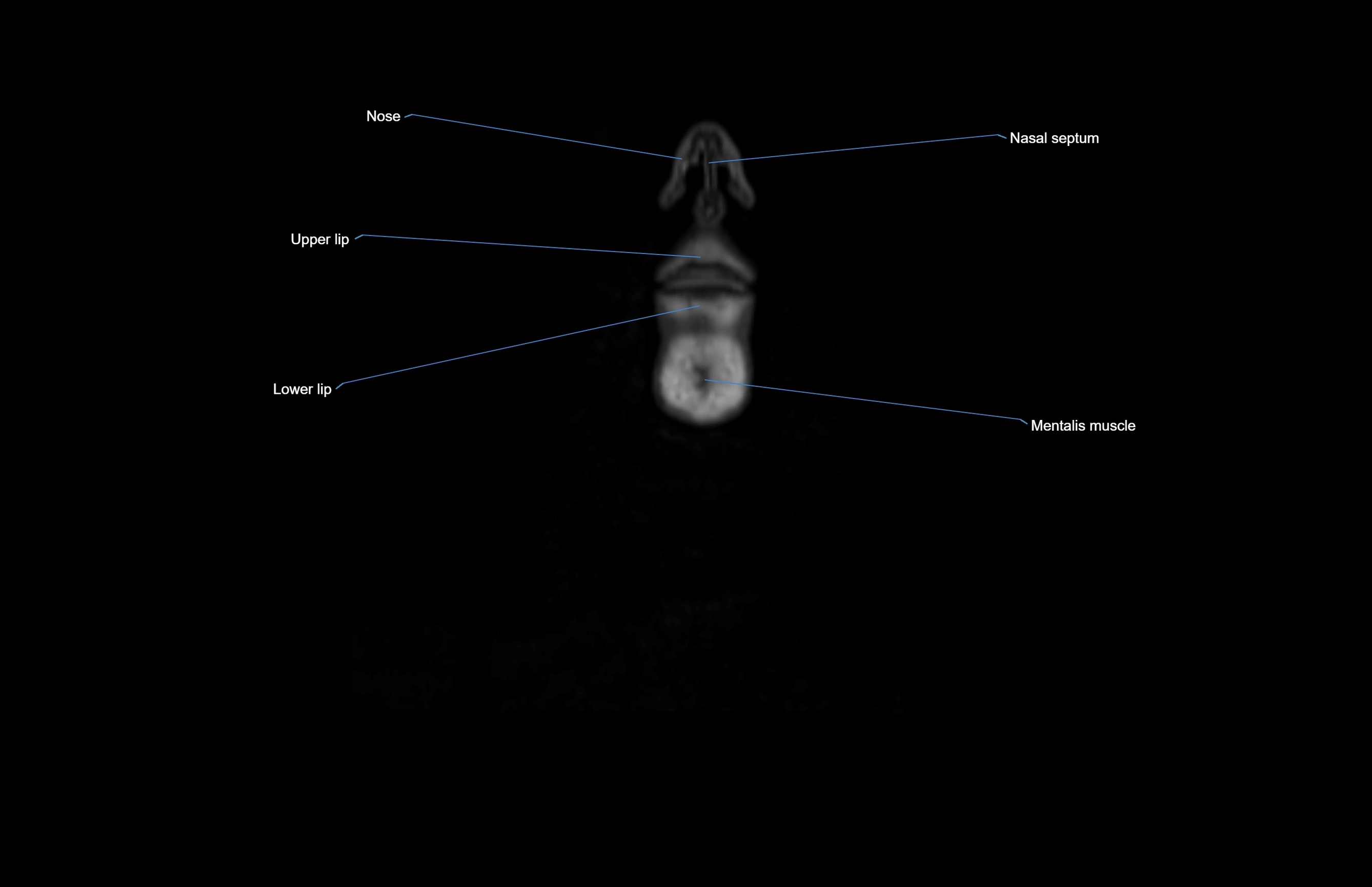 Neck coronal cross sectional MRI anatomy 3T MRI  image-img-00001-00082.webp